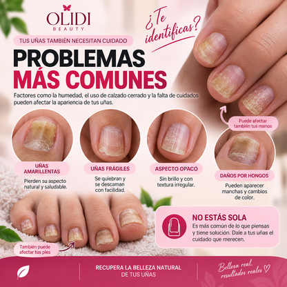 🍃🦶 Aceite Anti-Hongos para Uñas | Reparación Intensiva 30 ml • Resultados Visibles en 7 Días🔥